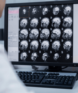 que sintomas indican tumor cerebral