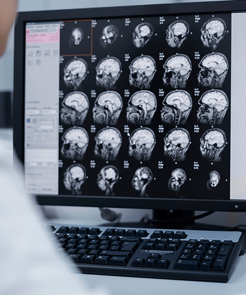 que sintomas indican tumor cerebral