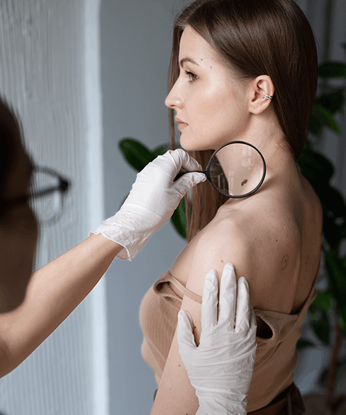 conoce el abcde del cancer de piel