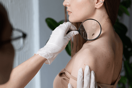 conoce el abcde del cancer de piel